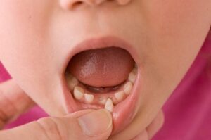 Hướng dẫn cách nhổ răng sữa cho bé