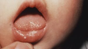 Làm gì khi trẻ sơ sinh bị nổi hạt trắng ở nướu răng và trong miệng?