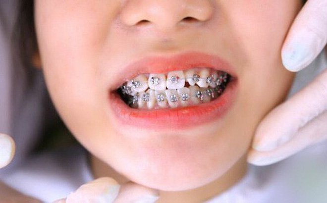 Có nên niềng răng cho trẻ 9 tuổi?