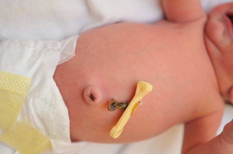 Trẻ sơ sinh sau khi rụng rốn bị chảy dịch