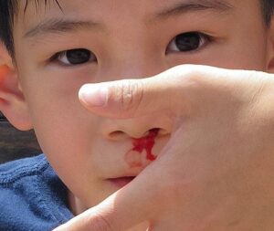 Khi nào chảy máu mũi ở trẻ em là nghiêm trọng?