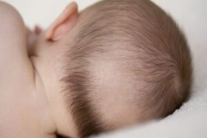 Các loại rụng tóc ở trẻ em