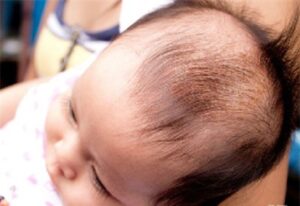 Cảnh giác viêm da đầu ở trẻ bị viêm da cơ địa