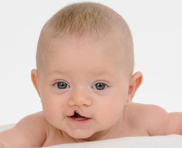 Khe hở môi, vòm miệng ở trẻ: Vì sao không nên phẫu thuật quá sớm?