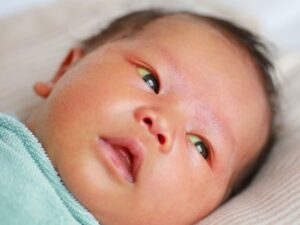 Lý do trẻ sơ sinh bị vàng mắt