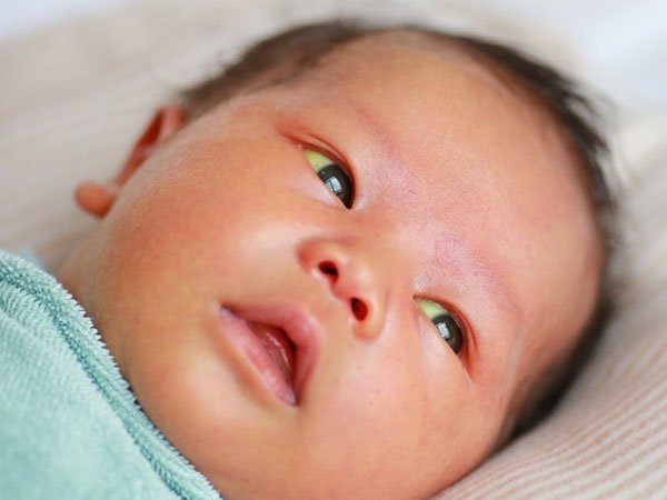 Lý do trẻ sơ sinh bị vàng mắt
