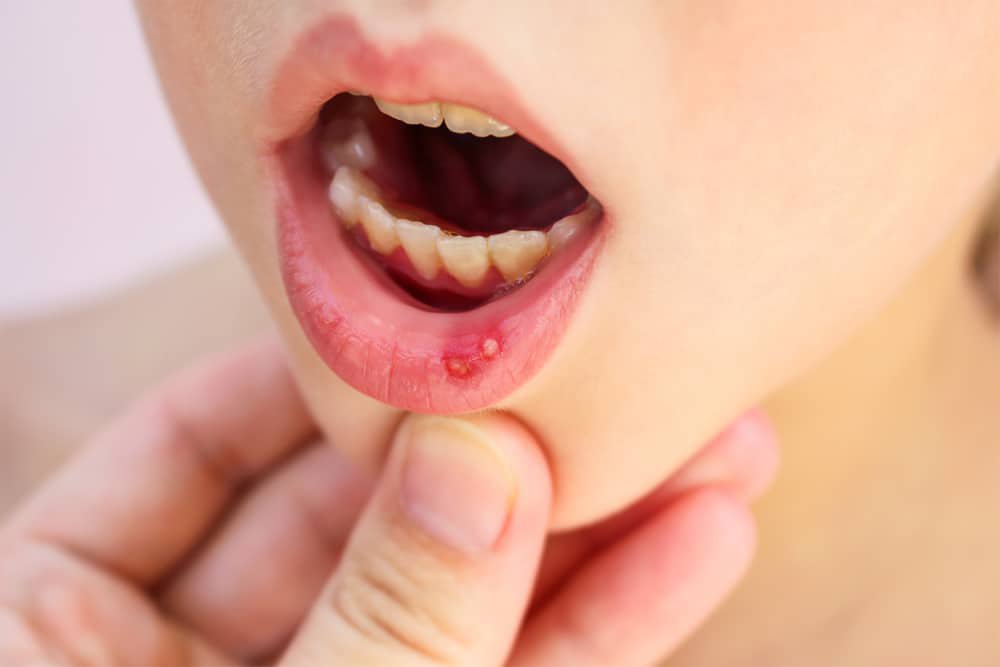 Trẻ bị nhiệt miệng chữa thế nào nhanh khỏi?