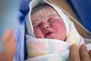 Trẻ sơ sinh có nhiều gây trên da có phải là bình thường?