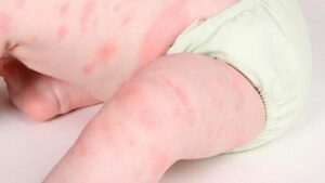 Nổi mề đay do côn trùng đốt ở trẻ nhỏ: Triệu chứng và cách xử lý