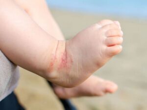 Làm cách nào để điều trị vết côn trùng cắn ở trẻ?