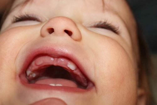 Trẻ 17 tháng tuổi: Chế độ dinh dưỡng và chăm sóc răng miệng