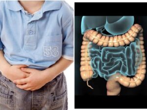 Hội chứng ruột kích thích ở trẻ em: Những điều cần biết