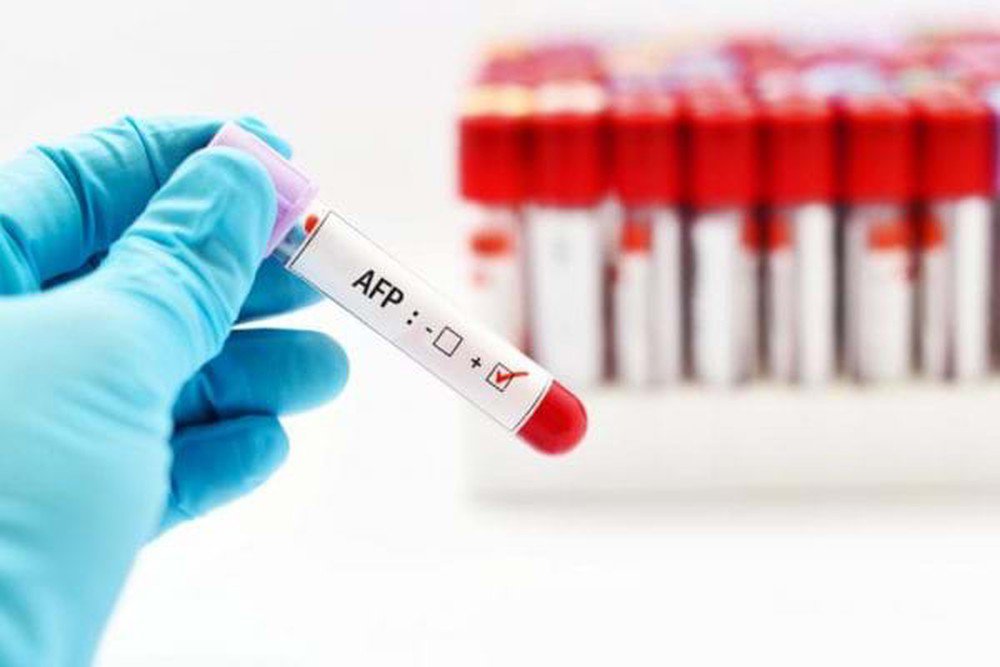 Kết quả xét nghiệm AFP 12,5 ng/dl nhưng kết quả men gan, anti HBS 102 U/l viêm gan C bình thường có sao không?
