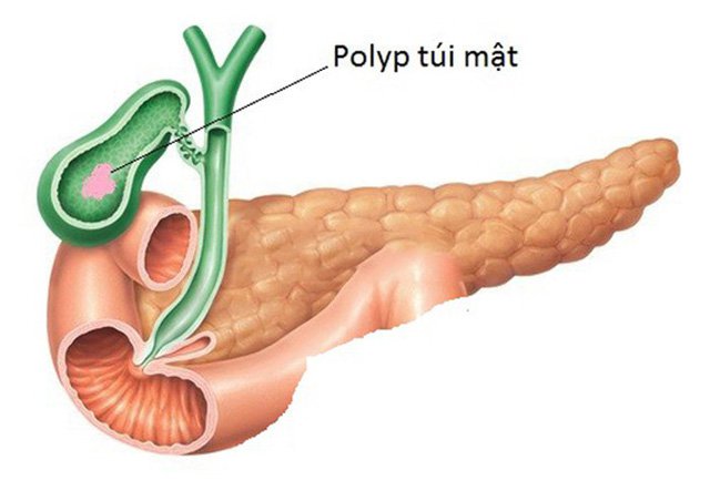 Đa polyp túi mật điều trị được không hay phải mổ?