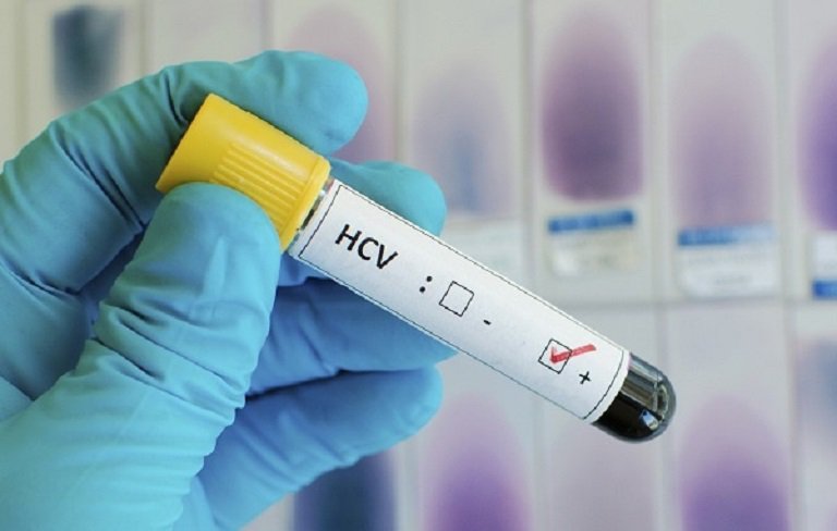 Kết quả xét nghiệm Anti HCV = reactive 2,51 cần làm gì?