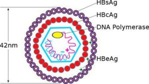 HBV tải lượng: 2,79×10^8 IU/mL, HBeAb (-), HBeAg (+), men gan bình thường là viêm gan B cấp tính hay mạn tính?