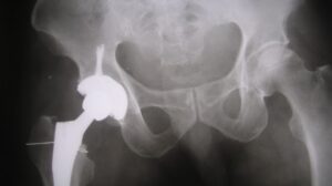 Nam giới bị Osteosarcoma đầu dưới xương đùi có phẫu thuật được không?