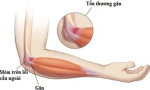 Nứt xương lồi cầu trong cánh tay trái có nguy hiểm không và cách điều trị?