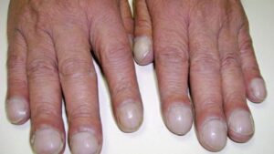 Ngón tay có biểu hiện ngón tay dùi trống có chữa được không và trở lại bình thường được không?
