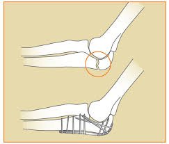Tay không thẳng ra được sau tháo bột nứt xương khuỷu tay phải điều trị thế nào?