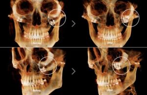 Phẫu thuật xương gò má và mũi sau tai nạn 1 năm có được không?