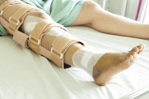 Chân khó gập duỗi sau phẫu thuật nẹp vít gãy xương đùi 1 năm nên làm gì?