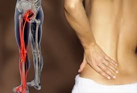 Đau lưng và đau bắp chân là dấu hiệu của bệnh gì?