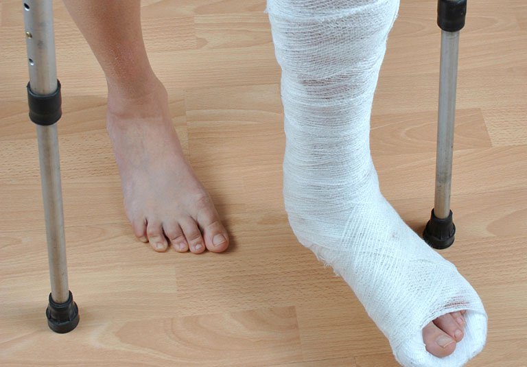 Sau khi đóng đinh nội tủy gãy xương cẳng chân bao lâu có thể tập đi lại?