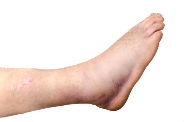 Bong gân chân nên điều trị thế nào?