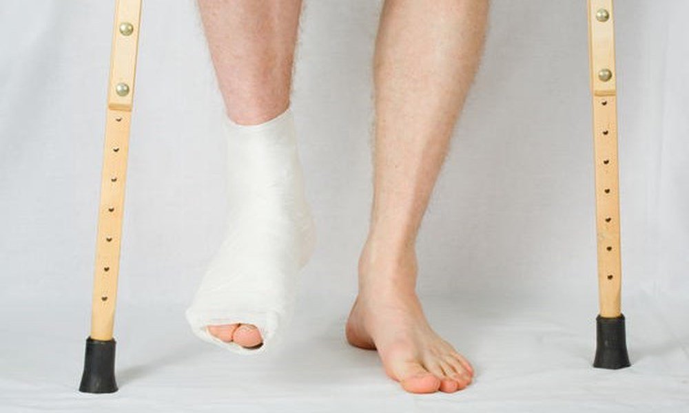 Bị sưng chân khi bó bột có sao không?