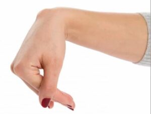 Nữ giới u nang hoạt dịch cổ tay có ảnh hưởng gì?