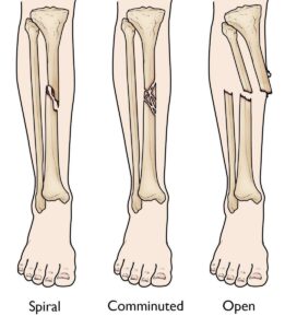 Nữ giới chân không duỗi thẳng sau khi vỡ xương chày nguyên nhân là gì?