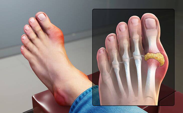 Đau ngón chân cái có phải dấu hiệu bệnh gout không?