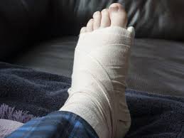Sau khi tháo bột điều trị gãy xương mác thì sau này cổ chân có ảnh hưởng gì không?
