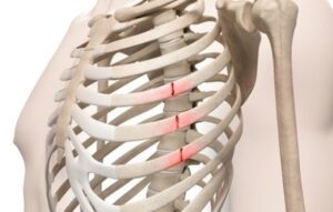 Sau va đập, ấn và hít thở mạnh thấy đau vùng xương sườn có khả năng bị gãy xương sườn không?