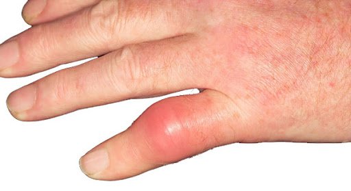 Ngón tay sưng đỏ, khó co nắm sau bó bột điều trị gãy xương là do đâu? Điều trị ra sao?