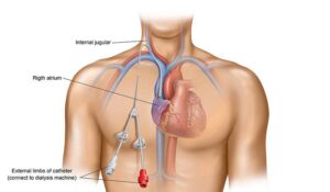 Ưu điểm của đặt catheter tĩnh mạch trung tâm dưới hướng dẫn siêu âm