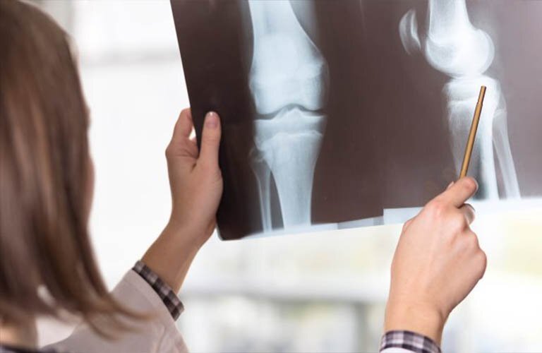 Chụp X – quang giúp bác sĩ có thể chẩn đoán xác định tổn thương sụn tăng trưởng
