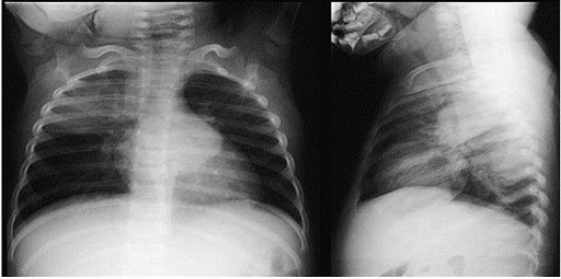 X-quang phổi trẻ sơ sinh